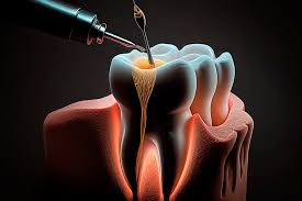 Endodoncia- Clínica dental La Asunción