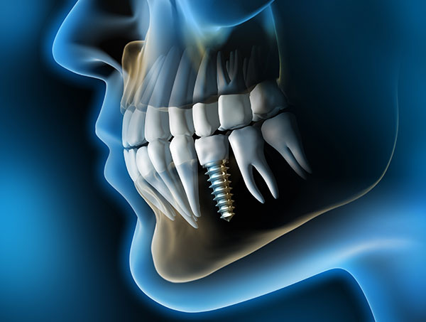 implantes dentales - Clínica dental La Asunción