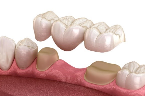 prostodoncia - Clínica dental La Asunción